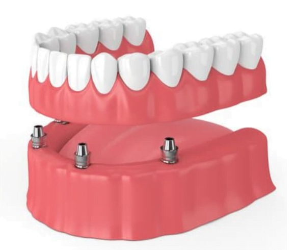 What Is A Dental Implant Urban Smiles